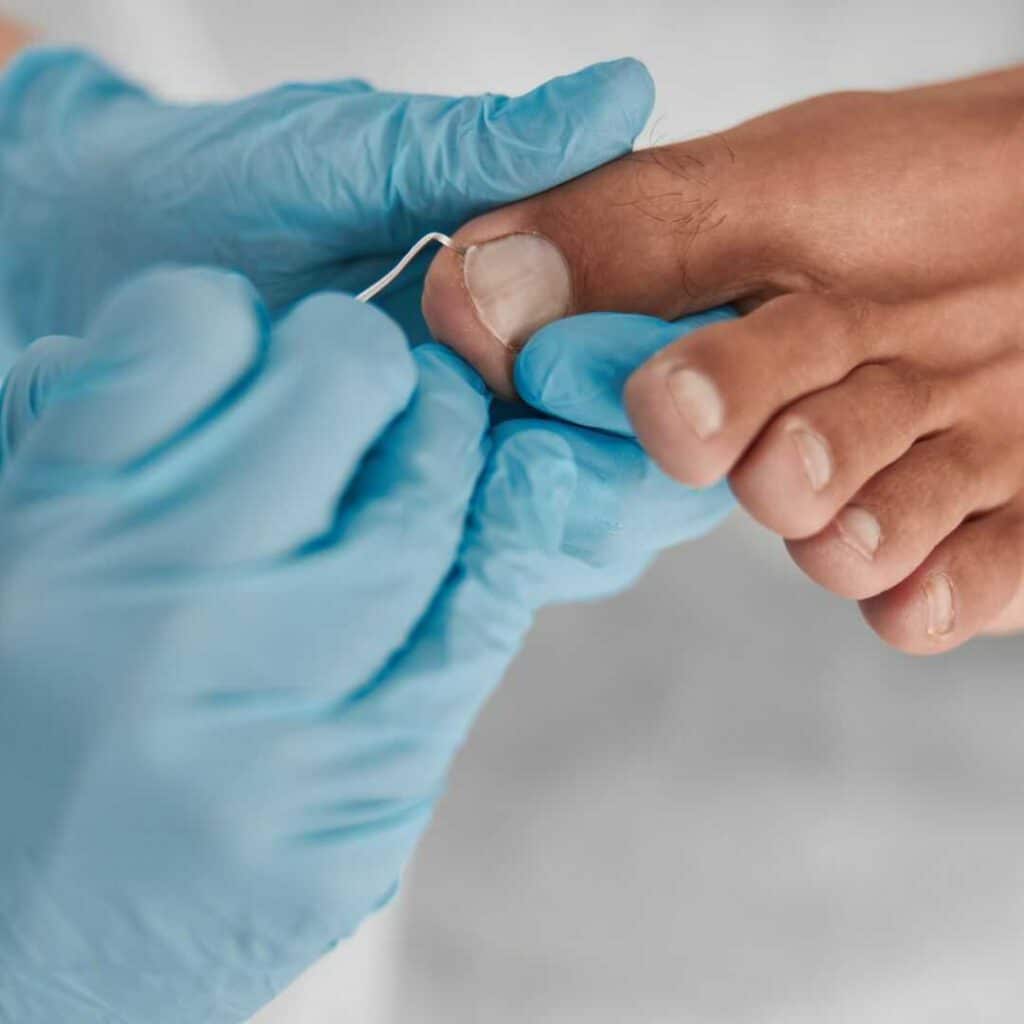 טיפול בציפורן חודרנית