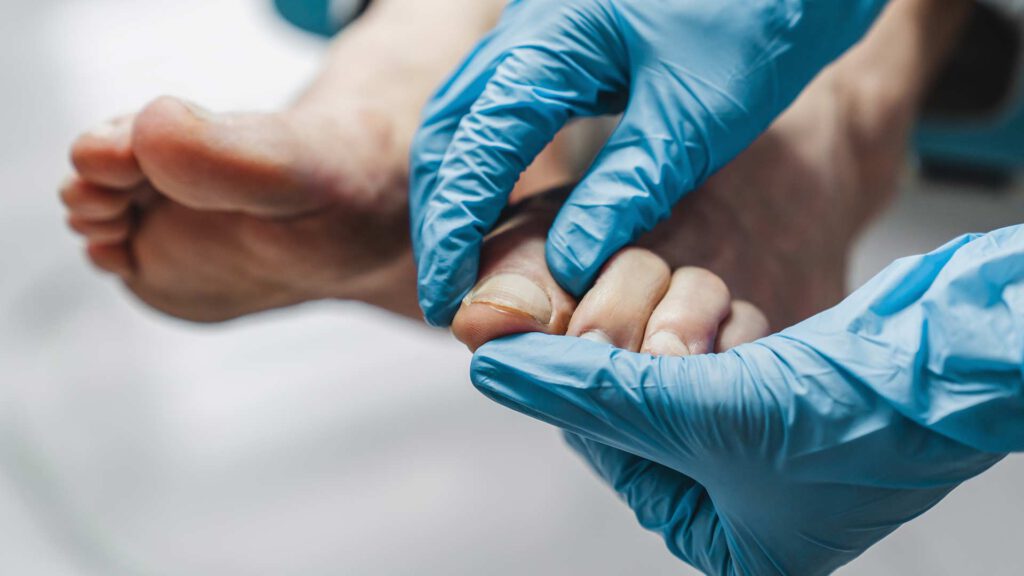 טיפול בפטרת ציפורניים