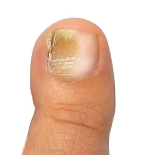 לפני טיפול בפטרת ציפורניים