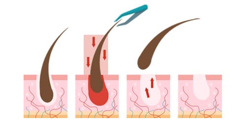 עיצוב גבות - מריטה של פינצטה מהשורש