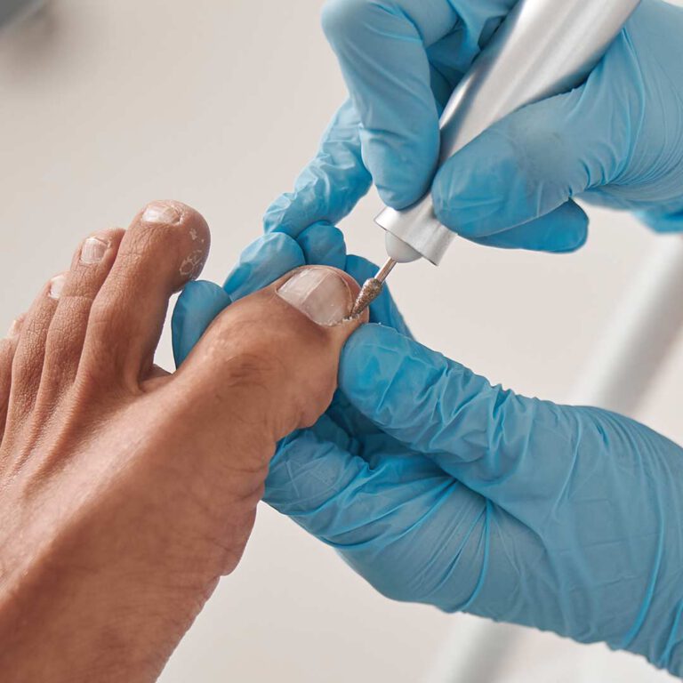 טיפול פדיקור רפואי - טיפול בבוהן + ניקוי תעלות