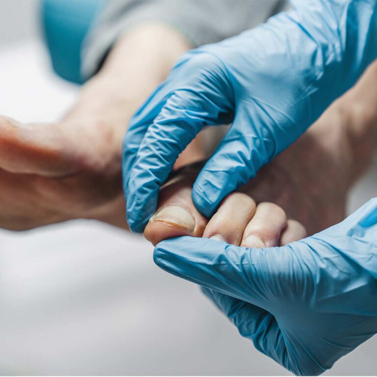 טיפול בפטרת ציפורניים