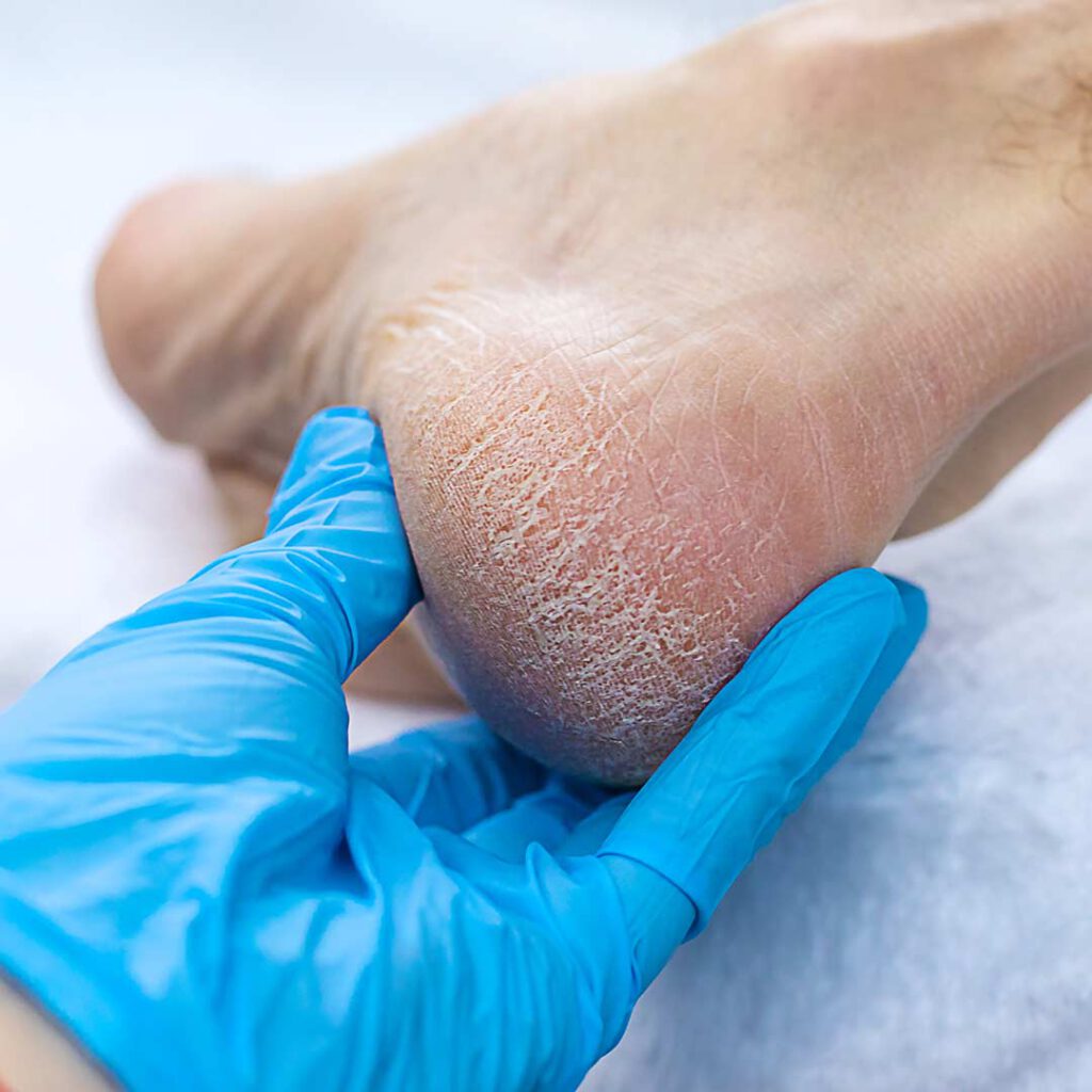 טיפול בעור קשה יבש וסדוק