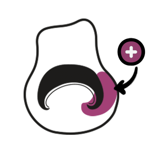 טיפול בציפורן חודרנית