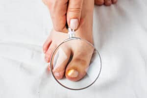 האם פטרת ציפורניים מדבק והאם חשוב להיזהר?