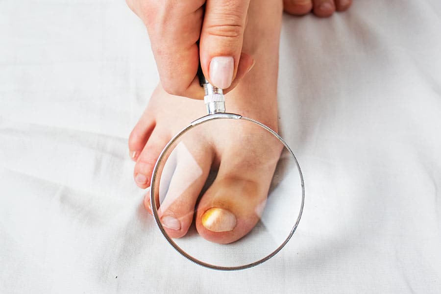 האם פטרת ציפורניים מדבק והאם חשוב להיזהר?