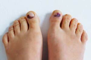 הופעה של ציפורן שחורה, הידועה גם בשם המטומה תת-רחית, יכולה להיות מדאיגה, והבנת הסיבות שגרמו לזה וההשלכות שלה היא חיונית. מאמר זה בוחן את הסיבות מאחורי דימום בציפורניים, גורמים אחרים התורמים לדימומים, ואילו צעדים ניתן לנקוט לטיפול ומניעה של בעיה זו.