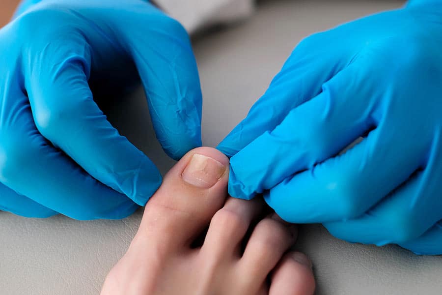 מהזה אוניכוליזיס ממה הוא נובע ומה דרכי הטיפול בבעיה-אוניכוליזיס היא הפרעת ציפורניים שכיחה המאופיינת בהפרדה של צלחת הציפורן ממיטת הציפורן. מצב זה לא רק משפיע על מראה הציפורניים אלא יכול גם להוביל לאי נוחות וסיבוכים פוטנציאליים אם אינו מטופל. הבנת הסיבות לאוניכוליזיס ובחינת אפשרויות טיפול יעילות היא חיונית עבור אלה המתמודדים עם בעיית ציפורניים זו.