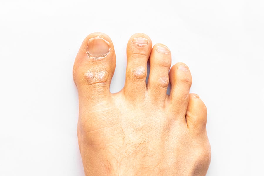 טיפול ביבלות בכף הרגל- הבנה ודרכי טיפול ביבלות בכף הרגל