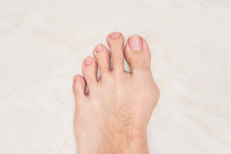 הלוקס ולגוס (Hallux Valgus), הידוע בכינויו בוניון, הוא עיוות נפוץ בכף הרגל המאופיין בסטייה לרוחב של הבוהן הגדולה בציפורניים