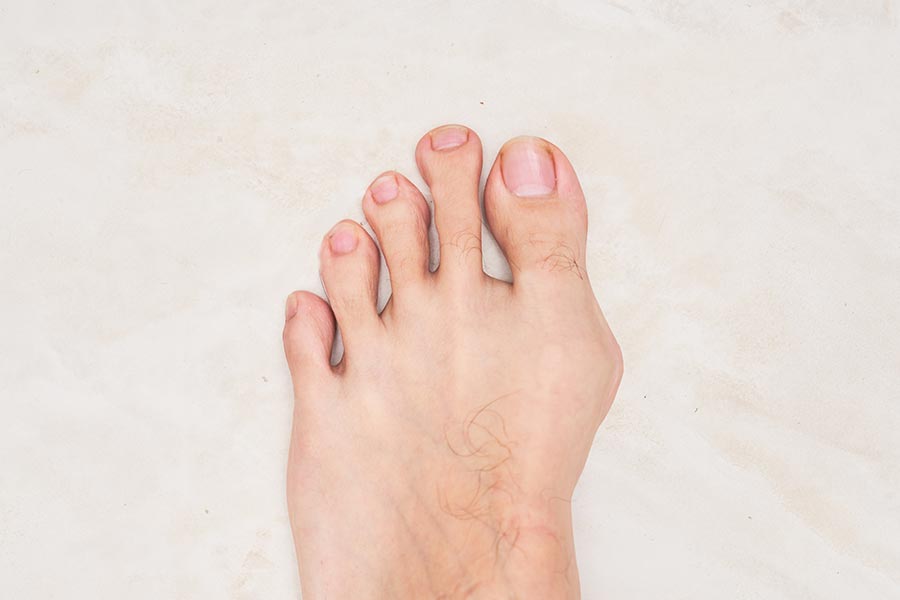 הלוקס ולגוס (Hallux Valgus), הידוע בכינויו בוניון, הוא עיוות נפוץ בכף הרגל המאופיין בסטייה לרוחב של הבוהן הגדולה בציפורניים
