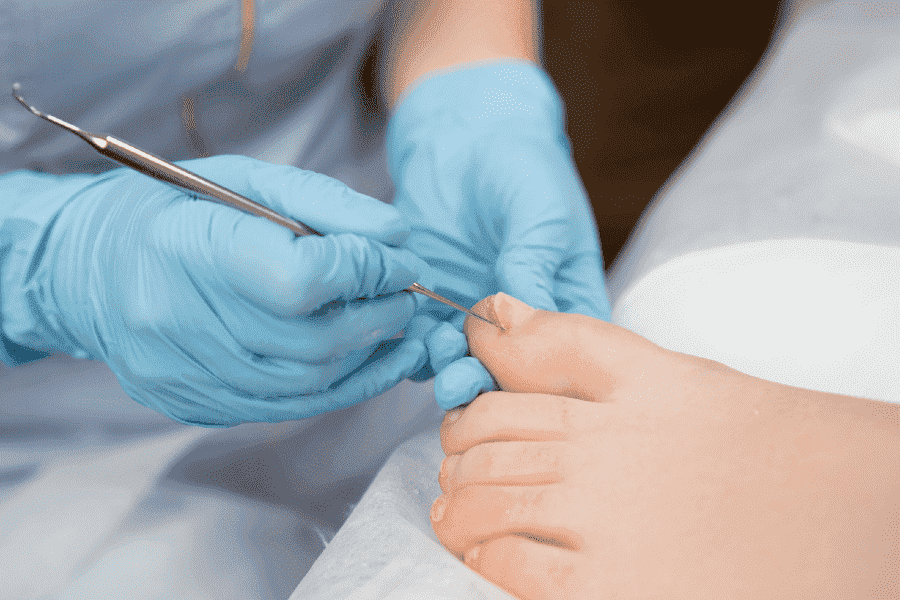 תמונה המציגה טיפול בחודרנית עם דלקת שנוצרה עקב טיפול בציפורן חודרנית.