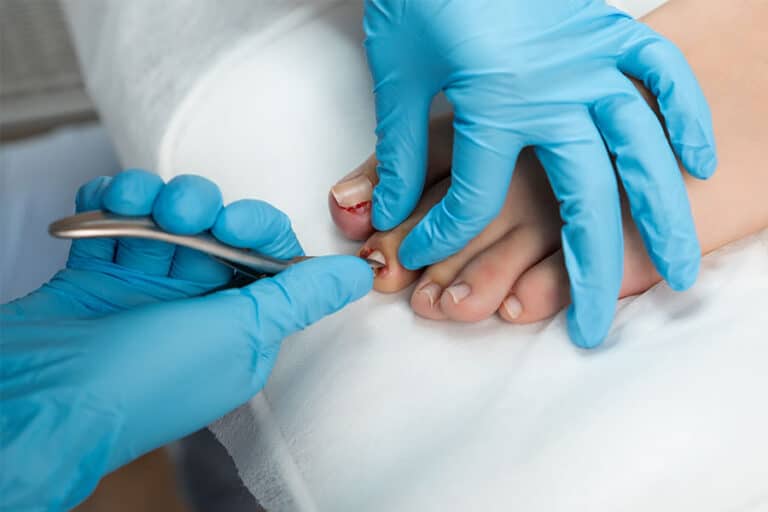 כף רגל באמצע טיפול בציפורן חודרנית, במאמר זה יהיה ניתן לקבל הנחיות מה כדאי לעשות לאחר טיפול בציפורן חודרנית.