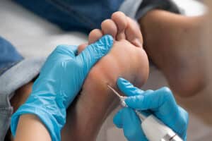 תמונה המציגה טיפול ביבלות בכף הרגל