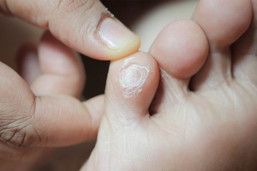 תמונה המציגה יבלות בכף הרגל באזור האצבעות